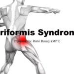 How to Manage pririformus syndrome pdf Effectively