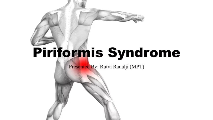How to Manage pririformus syndrome pdf Effectively