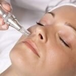 5 Benefits of Nano Needling You Should Know