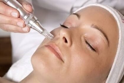 5 Benefits of Nano Needling You Should Know