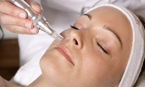 5 Benefits of Nano Needling You Should Know